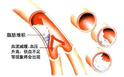 【科普】關於血脂指標的判斷