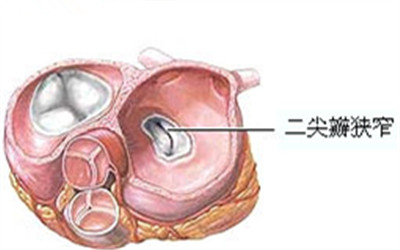 6種心髒瓣膜常見病變
