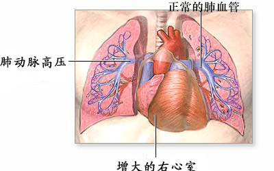 6種心髒瓣膜常見病變