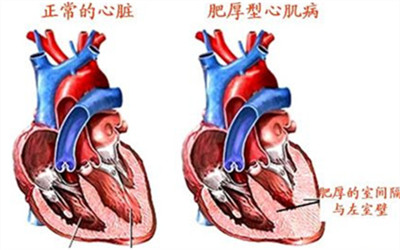 【鑒別】心髒辨膜病有哪些的類型？