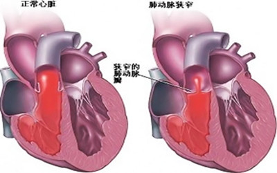 鑒別：心髒辨膜病有哪些的類型？