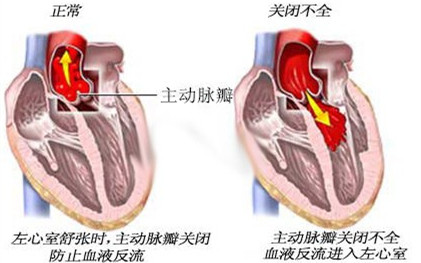 鑒別：心髒辨膜病有哪些的類型？