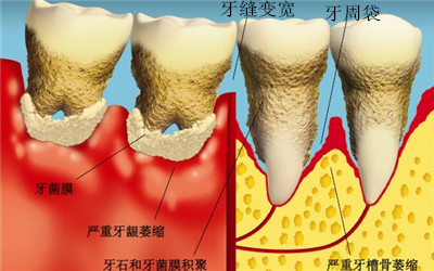 勤刷牙可降高血壓風險?