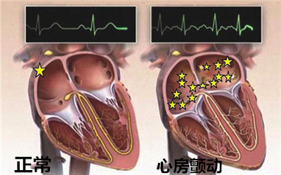 導致心房顫動病因有哪些？