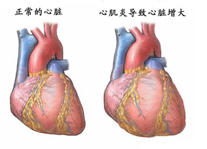 【科普系列】病毒性心肌炎知多少？