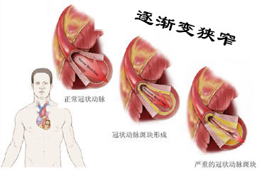 【盤點】7大病因，遠離動脈硬化