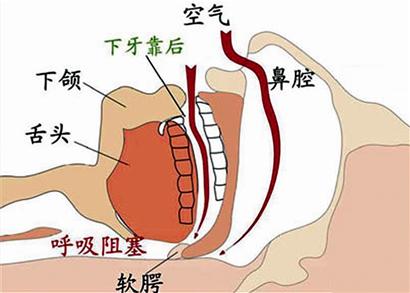 打鼾，你還以為是小事？