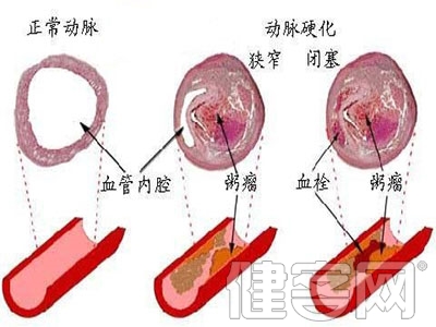 您真的患上“心肌缺血”了嗎？