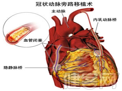 治療冠心病時，不可忽視疾病的並發症狀