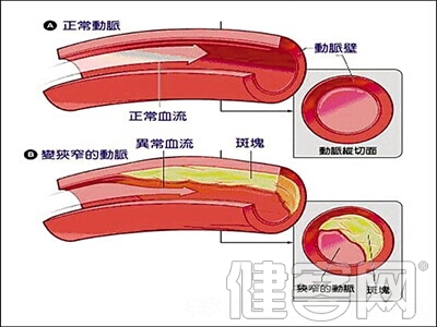 動脈粥樣硬化的藥物治療