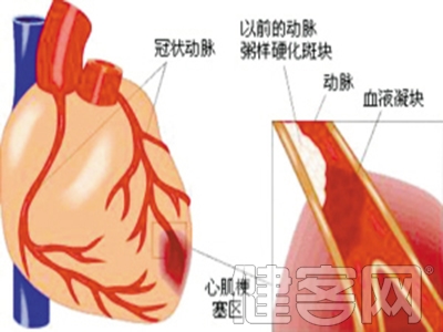 病毒性心肌炎怎麼治療呢