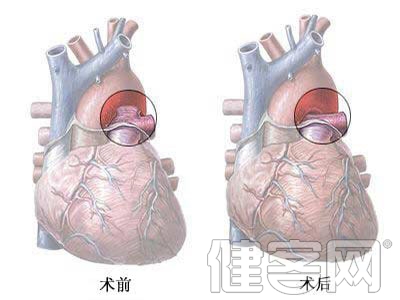 阿司匹林可作心梗一級預防