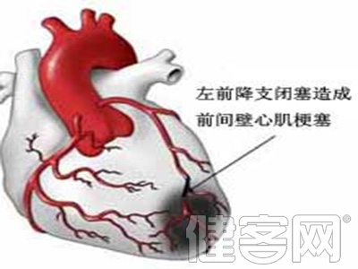 緊急救治心絞痛的方法