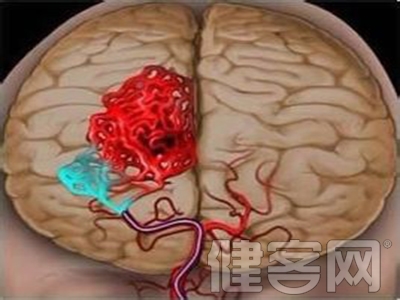 患上腦梗塞醫院怎樣科學的治療呢