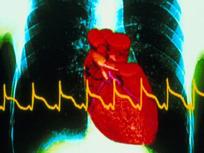 冠心病、心絞痛、心肌梗塞三者關系了解！