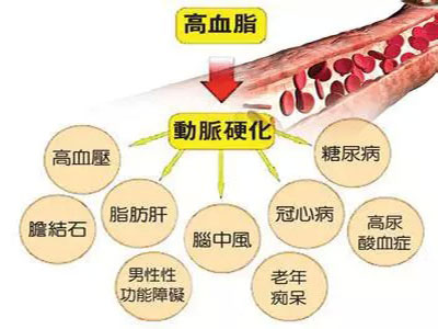 高脂血症認識的九大誤區