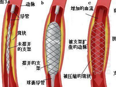 您真正了解冠心病嗎？