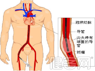 算一算，你的血管幾歲了