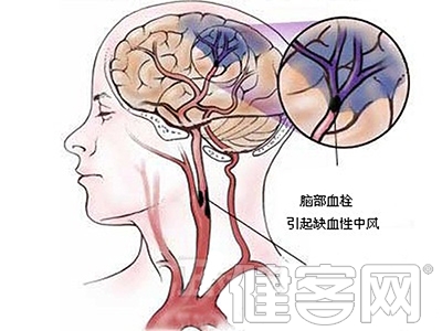 中風偏癱康復的幾大誤區 