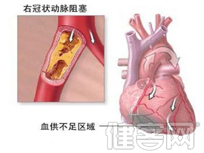 冠心病的診斷和治療