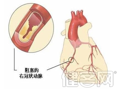 老年擴張性心肌病如何康復治療？