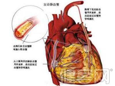 冠心病術後康復能鍛煉嗎