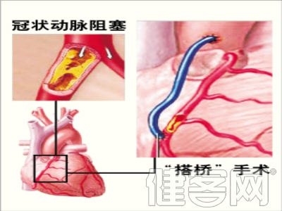 搭橋手術後心絞痛該怎麼辦