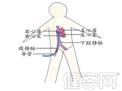 支架術後獨居再發風險高