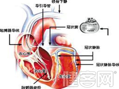 心血管病高發 血管也需精心“保養”