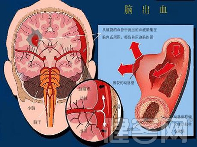 了解卒中症狀重視被動康復