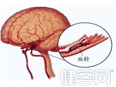 淺析偏癱康復治療中的六大誤區