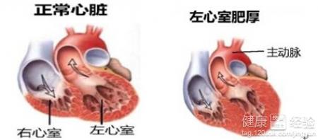 高血壓導致動脈硬化後的症狀