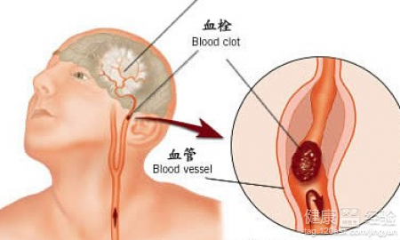 高血壓防治知識