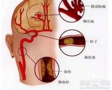 鼻子紅高血壓