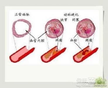 高血壓代代遺傳