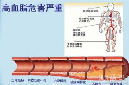 怎樣治高血脂