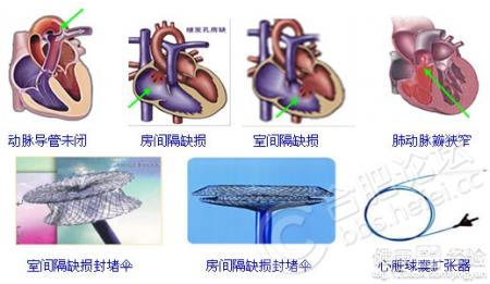 心髒病患者怎樣鍛煉？