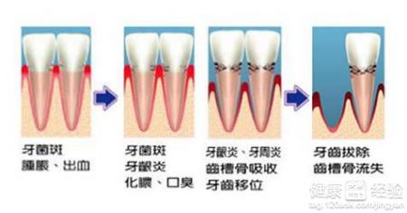 牙周炎為什麼會導致心髒病