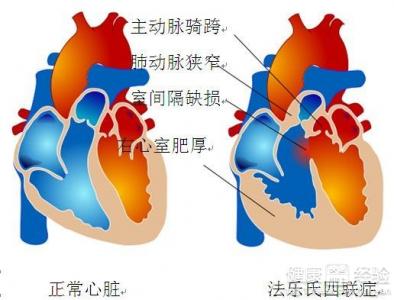 胎兒先天性心髒病有什麼危害