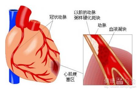 心髒病房顫嚴重嗎