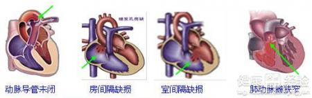 先天性心髒病會復發嗎