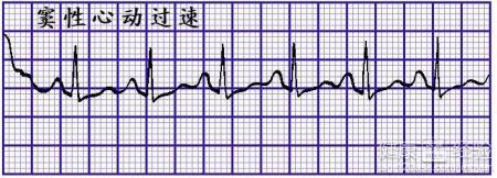 窦性心動過速是心髒病嗎是終身病嗎