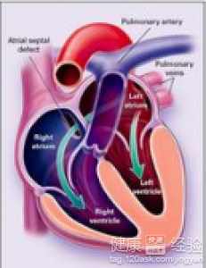 先天性心髒病室間隔缺損怎樣治療效果比較好