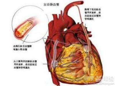 冠心病怎麼治療