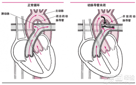 小兒先天性心髒病動脈導管未閉怎麼辦