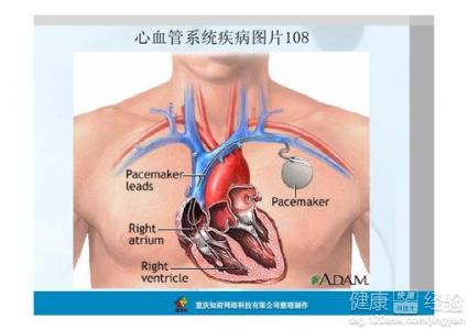 患了心律失常該怎麼辦