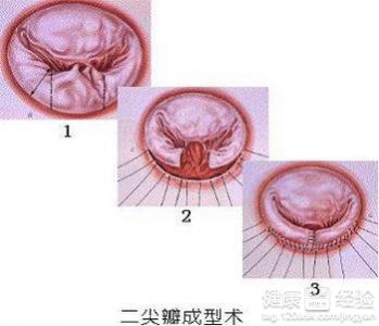 關於二尖瓣關閉不全的治療