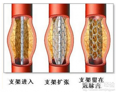 心髒支架術後一周療養最重要