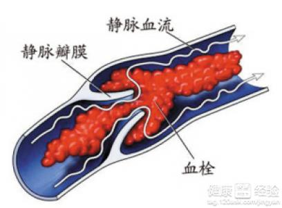 下肢深靜脈血栓的檢查診斷