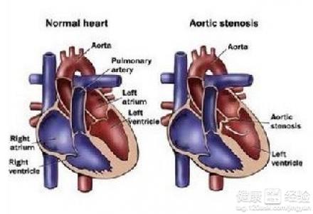 先天性主動脈瓣上狹窄的病因